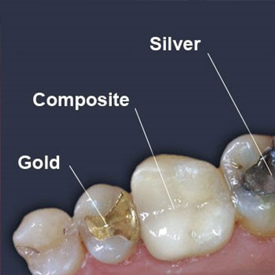 most widely used dental materials 1