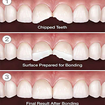 most widely used dental materials 4