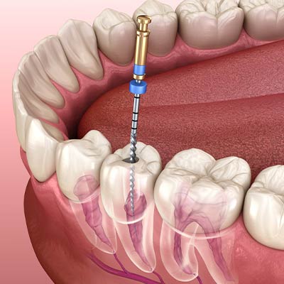 Endo dental set 13