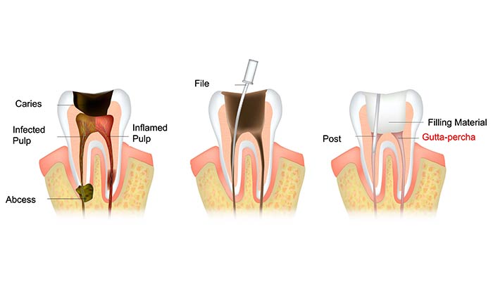 Endo dental set 6